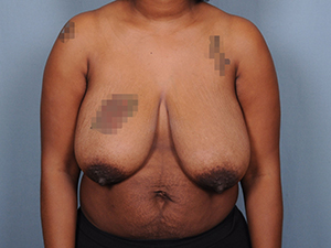 Breast Reduction Before & After Patient #1914