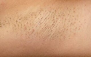 Best Laser Hair Removal New Bern NC Zannis Plastic Surgery