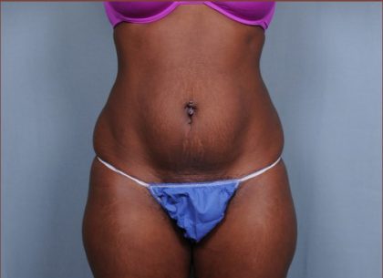 Liposuction Back and Flanks Treatment Gallery in New Bern, NC