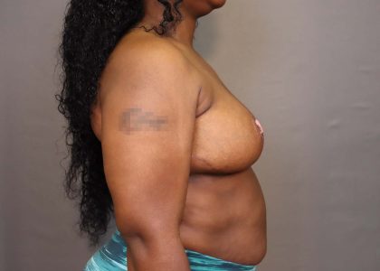 Breast Reduction Before & After Patient #3126