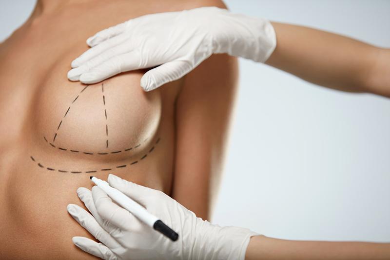 Breast Lift Zannis Center for Plastic Surgery